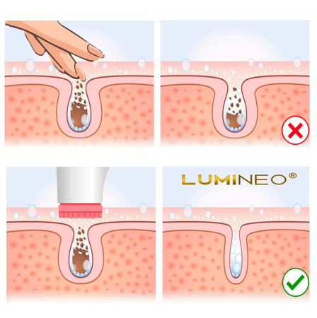 Szczoteczka do twarzy LUMINEO (różowa) + żel oczyszczający do skóry trądzikowej