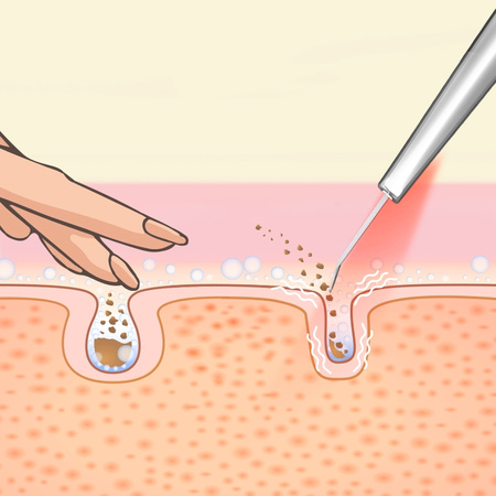 Peeling Kawitacyjny Led + tonik nawilżający LUMINEO